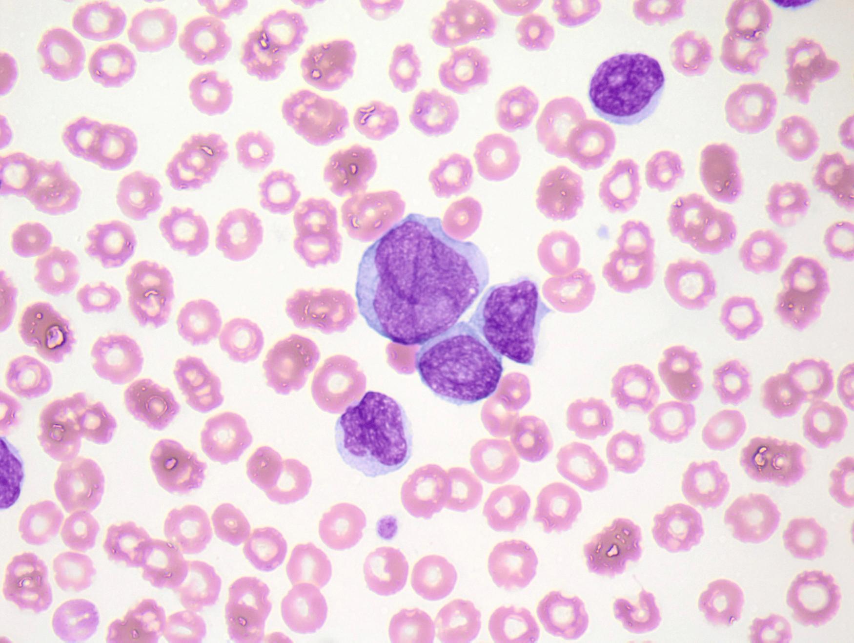 Fig. 10.21, B-cell prolymphocytic leukemia in peripheral blood. The prolymphocytes have finely reticulated, dispersed chromatin, morphologically mimicking myeloid blast cells.