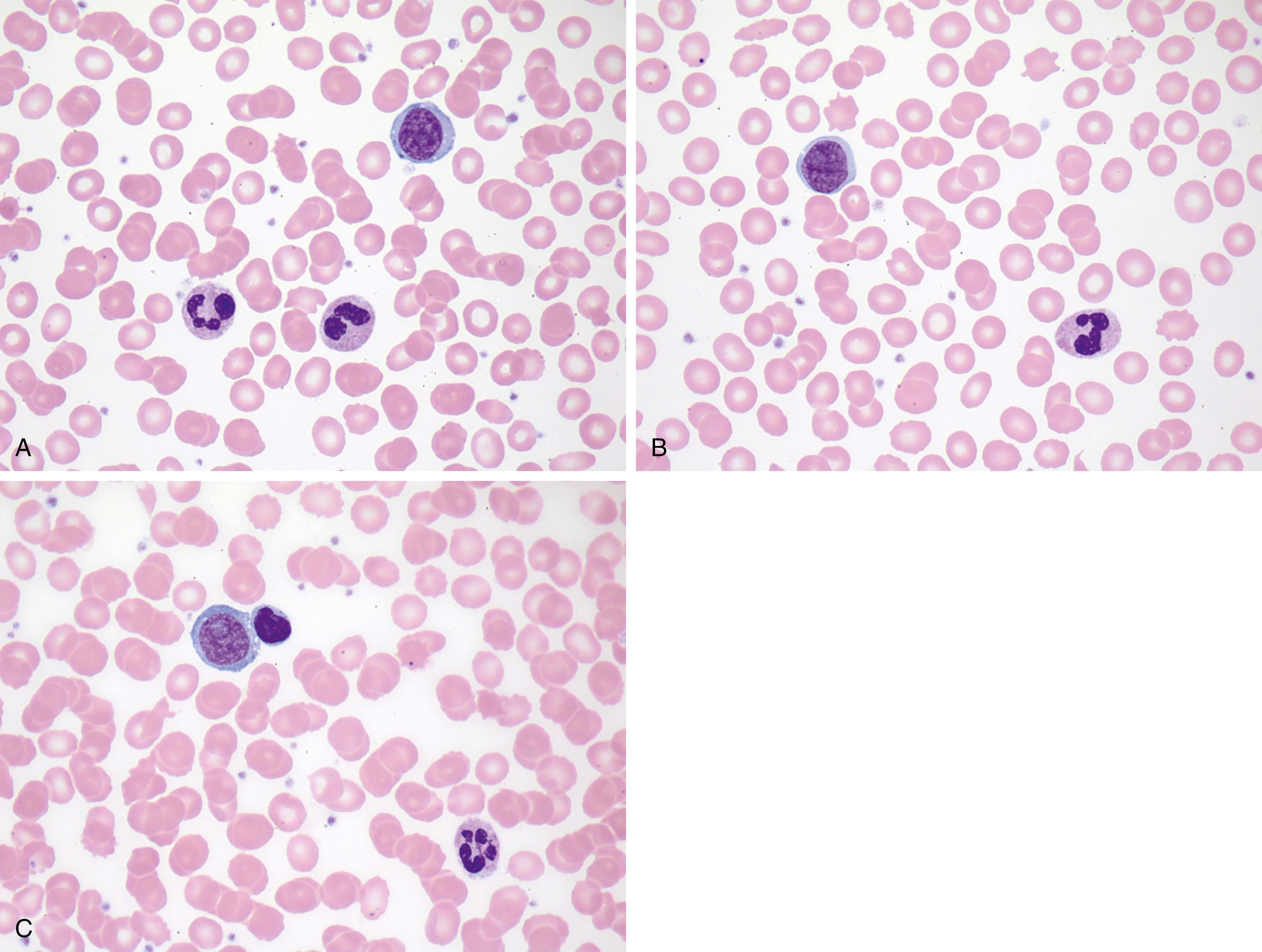 Fig. 10.22, Residual B-cell prolymphocytic leukemia after chemotherapy (peripheral blood). Prolymphocytes are infrequent on this blood smear and show nonclassic features including small cell size with (A) relatively condensed chromatin and inconspicuous nucleolus, or (B) small nucleoli and a suggestion of a nuclear groove. (C) Occasional classic prolymphocytes are also present.