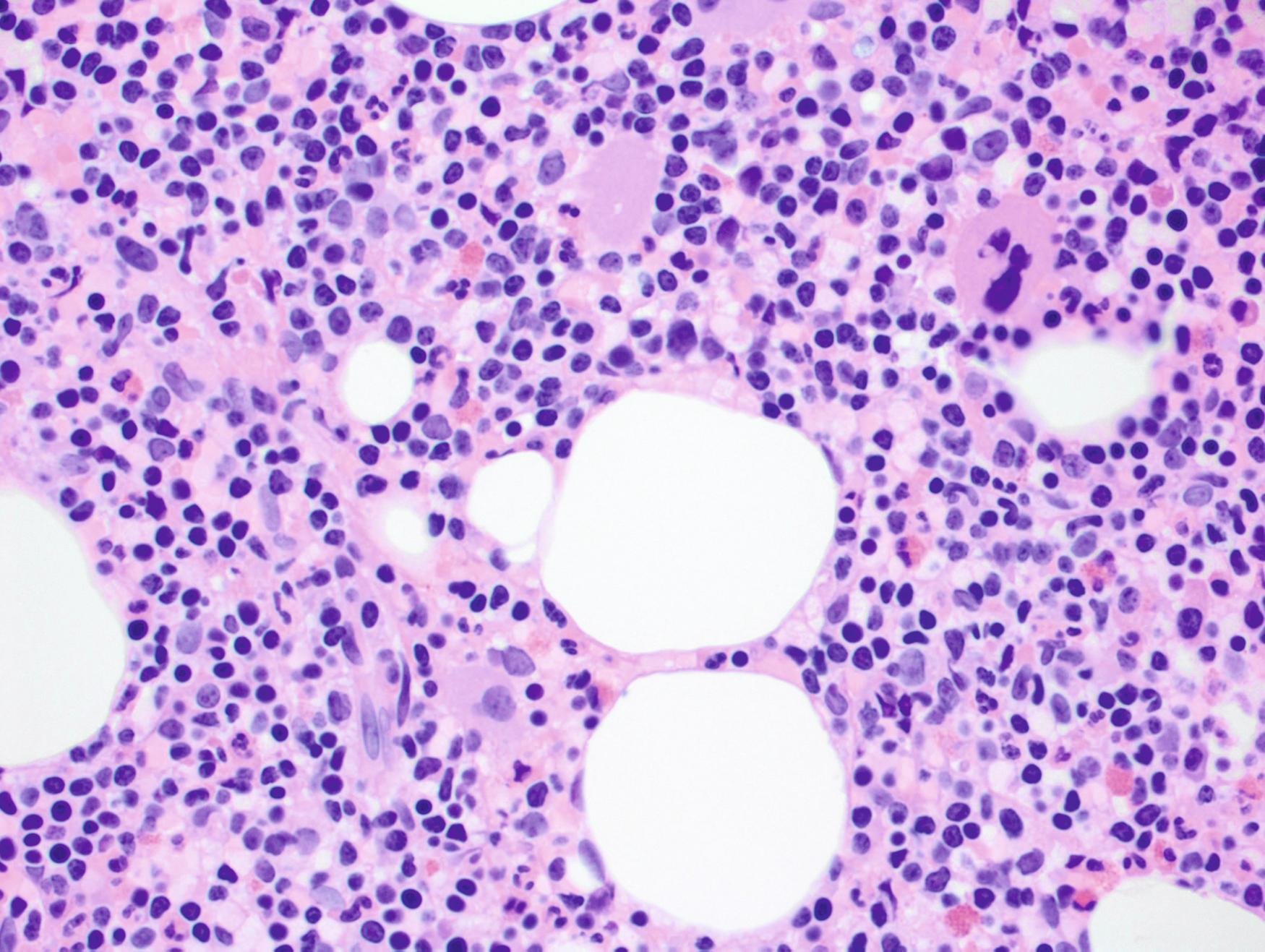 Fig. 10.23, Diffuse bone marrow involvement by B-cell prolymphocytic leukemia. A small amount of background trilineage hematopoiesis is present.