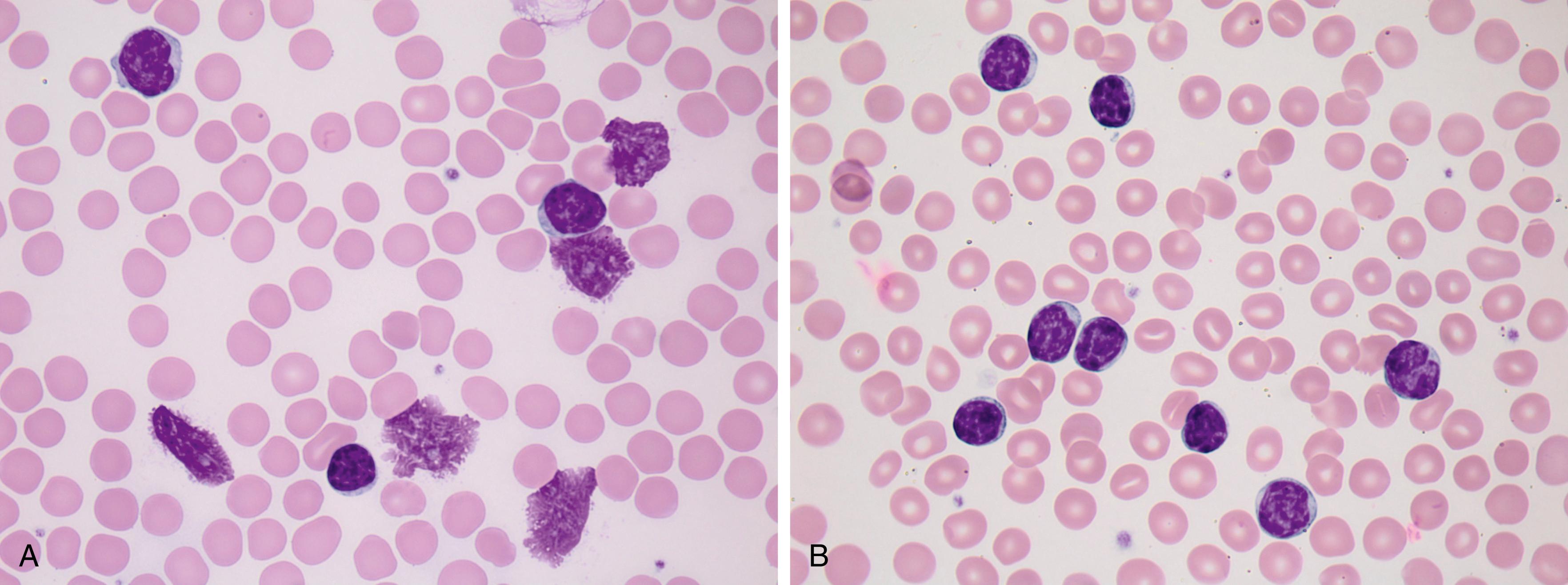 Fig. 10.7, Chronic lymphocytic leukemia (CLL) in peripheral blood. Neoplastic lymphocytes in CLL are typically small and have scant cytoplasm and condensed chromatin, often with cracks (so-called cracked earth or soccer ball chromatin). (A) Frequent smudge cells are common in CLL and arise as an artifact of slide preparation owing to the fragility of the neoplastic lymphocytes. (B) This blood smear is from the same patient but was prepared after adding a drop of albumin to the blood, which stabilizes the cell membranes and greatly reduces the number of smudge cells.