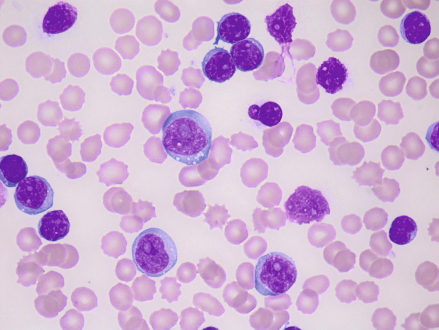 Fig. 10.9, Chronic lymphocytic leukemia (CLL) with increased prolymphocytes. This image demonstrates small lymphocytes and several smudge cells typical of CLL, but it also shows three larger prolymphocytes with more dispersed chromatin and a prominent central nucleolus. One cell at the left side of the image shows features intermediate between a typical CLL cell and a prolymphocyte and is difficult to classify.