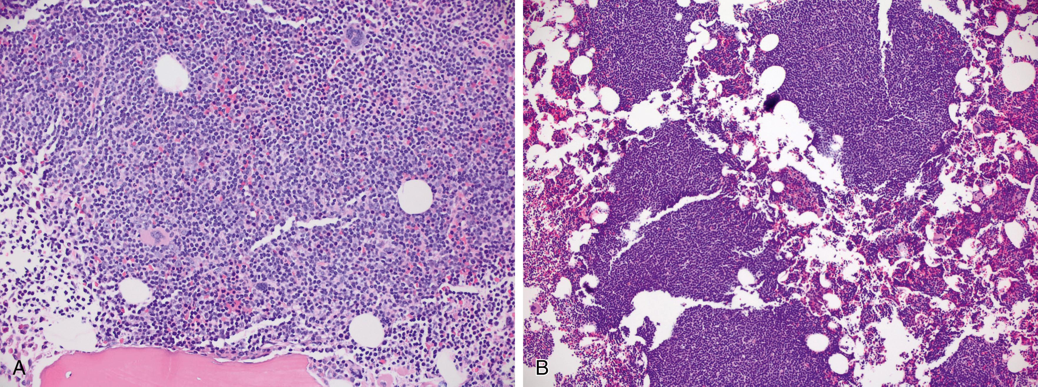 Fig. 10.10, Chronic lymphocytic leukemia/small lymphocytic lymphoma in bone marrow with (A) diffuse interstitial involvement by small lymphocytes, and (B) nodular involvement of the marrow interstitium.