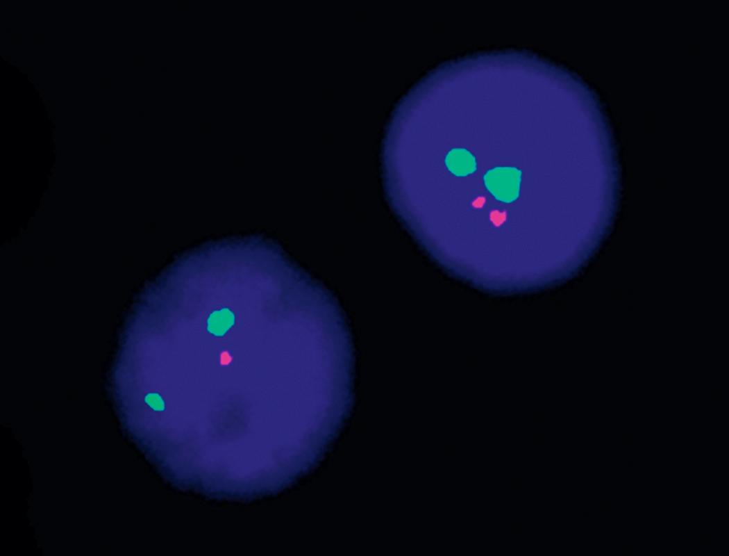 Fig. 10.13, Fluorescence in situ hybridization showing del(17p) in a patient with chronic lymphocytic leukemia/small lymphocytic lymphoma (CLL/SLL). A normal cell (upper right) contains two green signals for the centromere of chromosome 17 and two red signals for the 17p13.1 locus. The cell in the lower left contains only one red signal, indicating del(17p). This deletion involves loss of the TP53 gene and is associated with a poor prognosis in CLL/SLL.