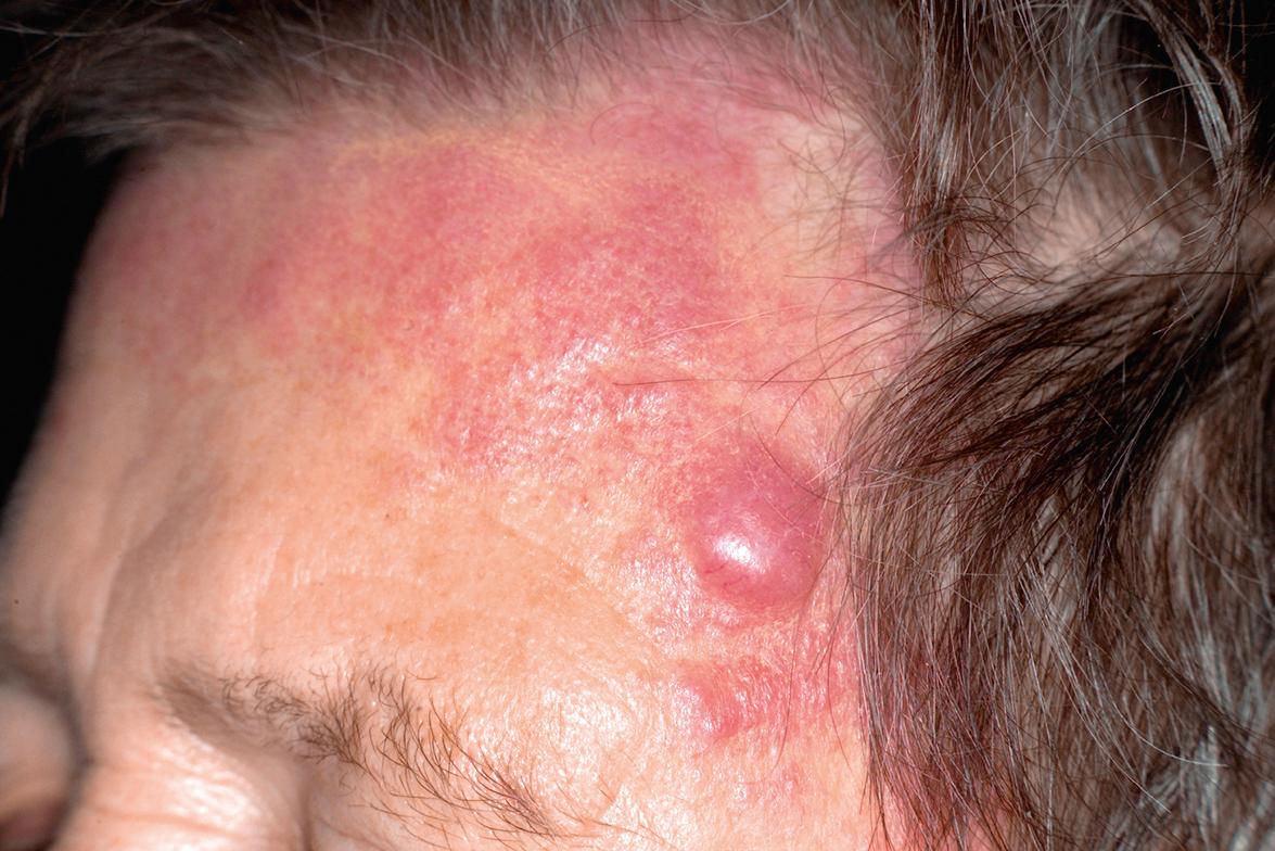 Fig. 119.1, Cutaneous follicle center lymphoma.