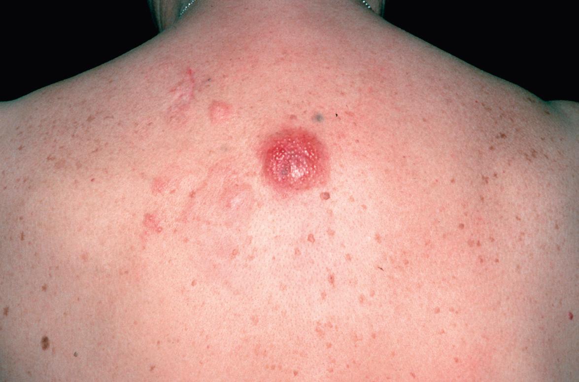 Fig. 119.2, Cutaneous follicle center lymphoma.