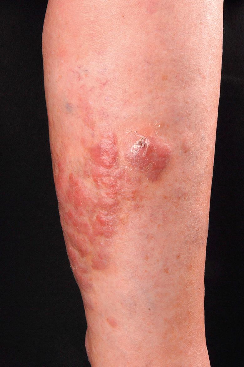 Fig. 119.5, Cutaneous diffuse large B-cell lymphoma, leg type.