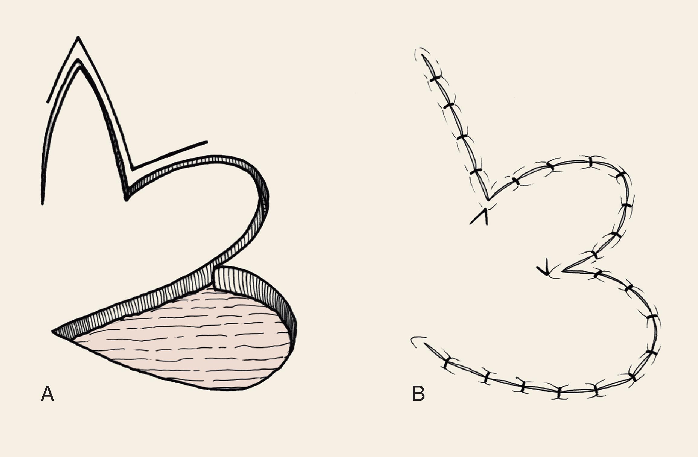 FIG. 10.1, A , Flap incised. B , Flap transfered to recipient site. Bilobe flaps are modified Z-plasties that reposition skin adjacent to the defect and two lobes of flap. This results in greater distribution of wound closure tension than single lobe transposition flaps.