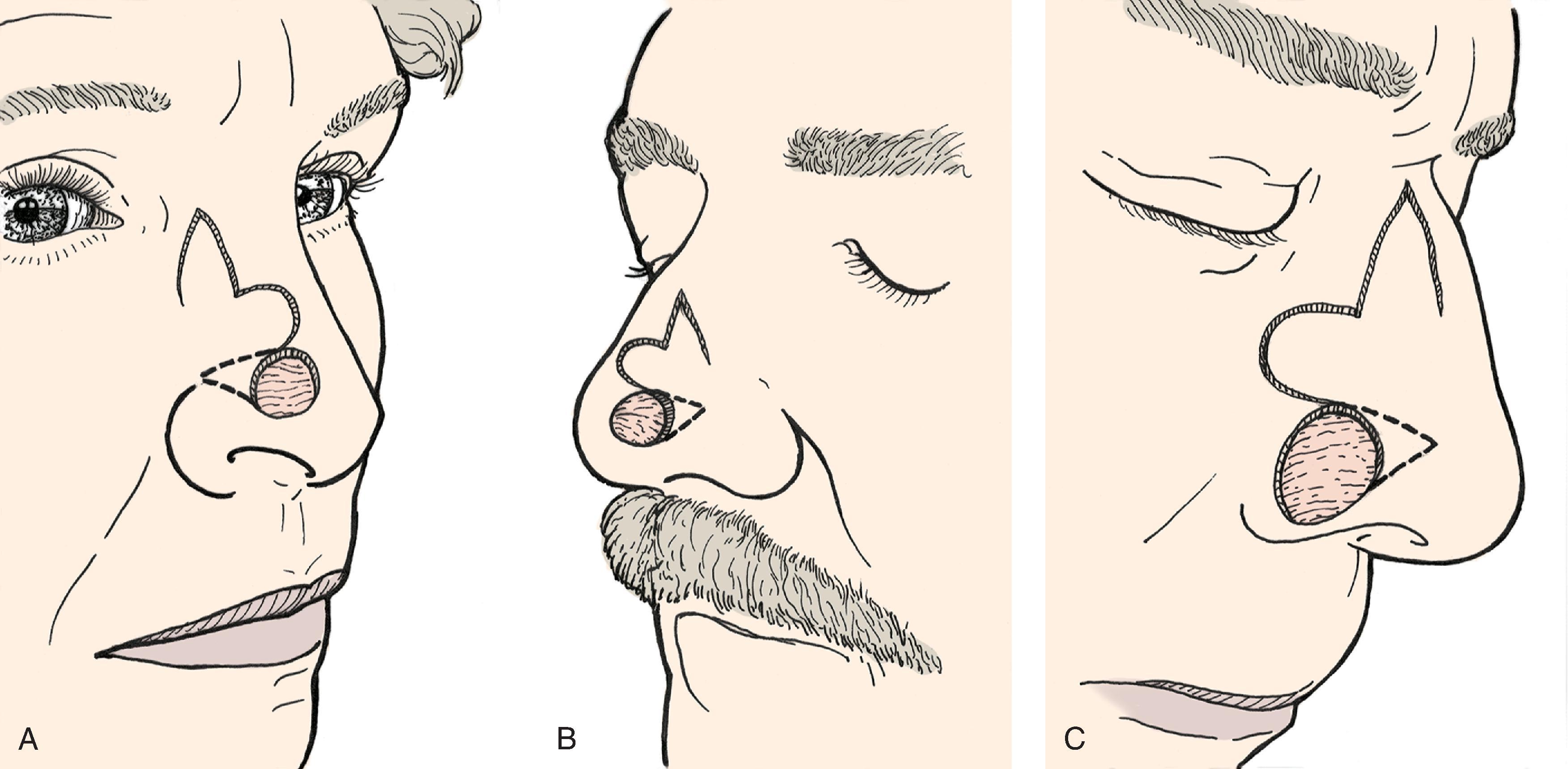 FIG. 10.2, Variations of bilobe flap used to repair caudal nasal cutaneous defects. (From Zitelli JA, Baker SR: Bilobe flaps. In Baker SR, Swanson NA [eds]: Local Flaps in Facial Reconstruction. Mosby, 1995, pp 170-174, Figs. 5B, 7B, 9B with permission.)