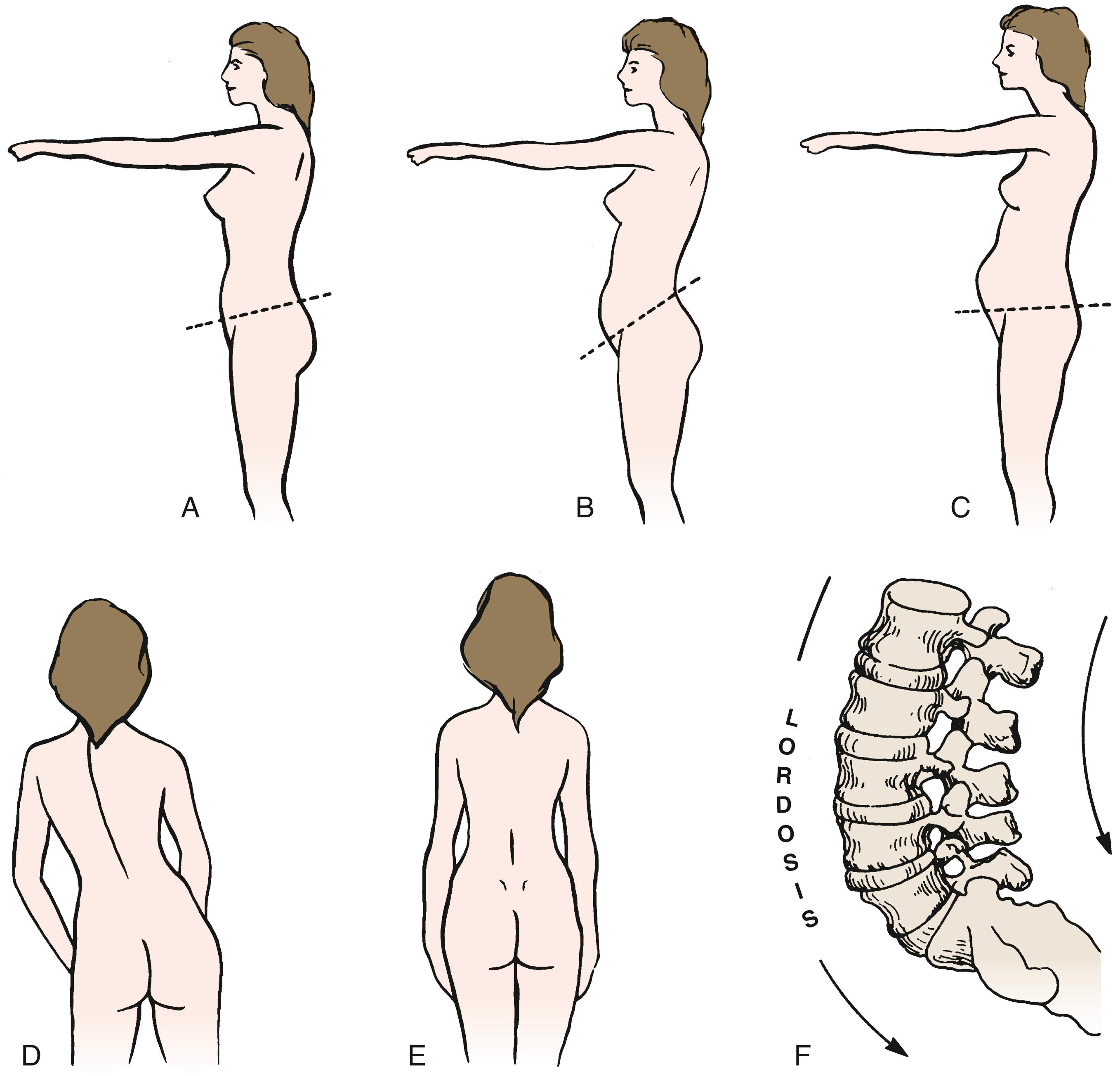 Fig. 46.1, A, Normal posture with normal lumbar lordosis. B, Exaggerated lumbar lordosis caused by pelvic tilting. C, “Paunchy” posture. D, Spastic scoliosis caused by muscle spasm. E, Normal posture without scoliosis. F, The normal orientation of the lumbar spine is that of mild lordosis. Exaggerated lordosis may predispose the patient to mechanical back pain.