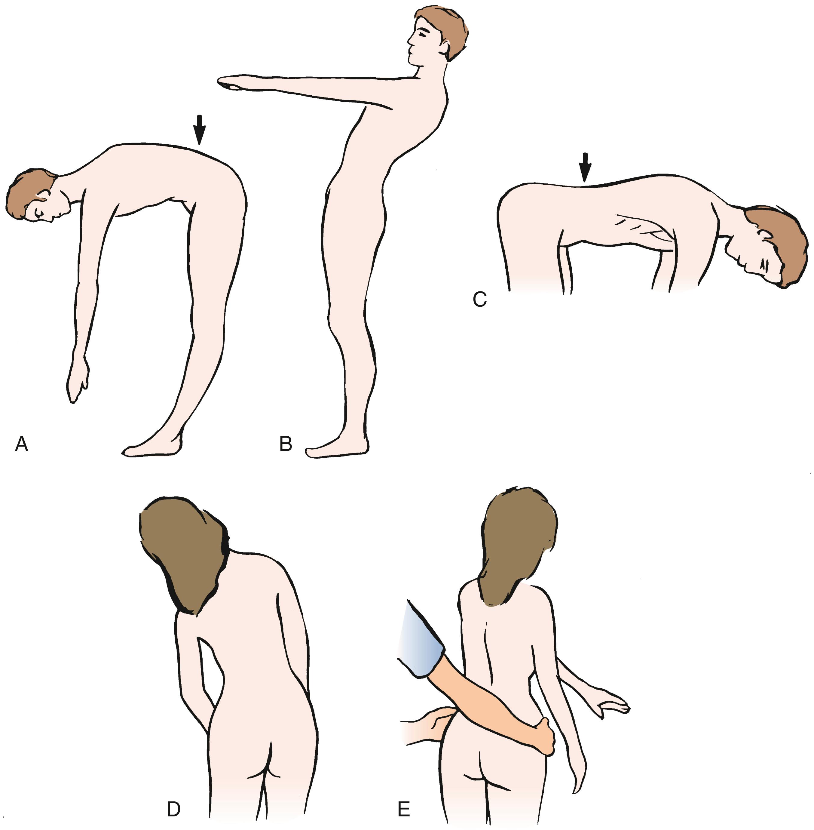 Fig. 46.2, Back range of motion. A, Flexion. Note the normal reversal of lumbar lordosis during flexion (arrow) . B, Extension. C, Persistent lordosis during back flexion as a result of muscle spasm (arrow) . D, Lateral flexion. E, Lateral torsion (rotation) .