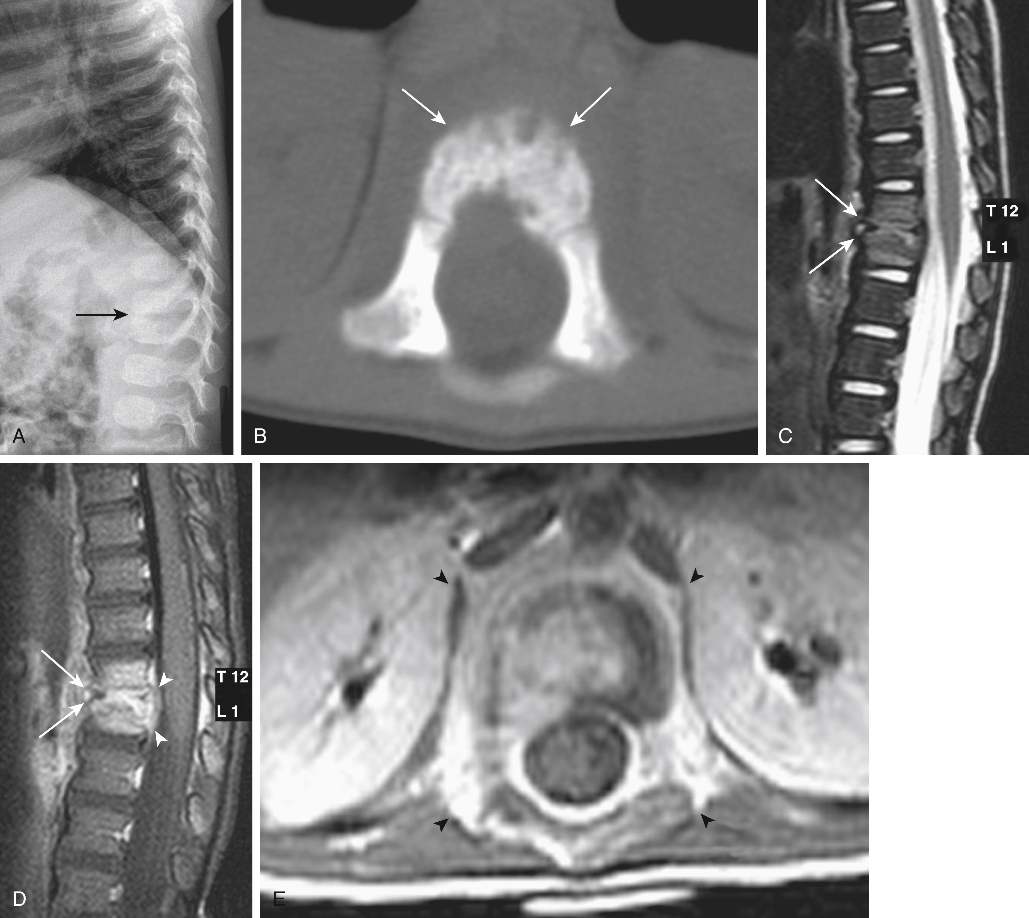 Fig. 46.6, Diskitis/osteomyelitis in a 15-month-old female with abnormal gait and concern for intraspinal mass. A, Lateral spine radiographs demonstrate narrowing of the T12–L1 intervertebral disk space (arrow) . B , Axial noncontrast CT of the spine demonstrates irregularity to the vertebral end plates (arrows) . Sagittal T2-weighted (C) and sagittal fat-saturated postcontrast T1-weighted (D) images and axial postcontrast T1-weighted MRI (E) of the thoracolumbar junction demonstrate loss of height of the T12–L1 intervertebral disk space with T2 prolongation of the adjacent end plates ( arrows in C ), with corresponding abnormal enhancement in the same regions ( arrows in D ) and surrounding masslike soft tissue enhancement ( arrowheads in E ).