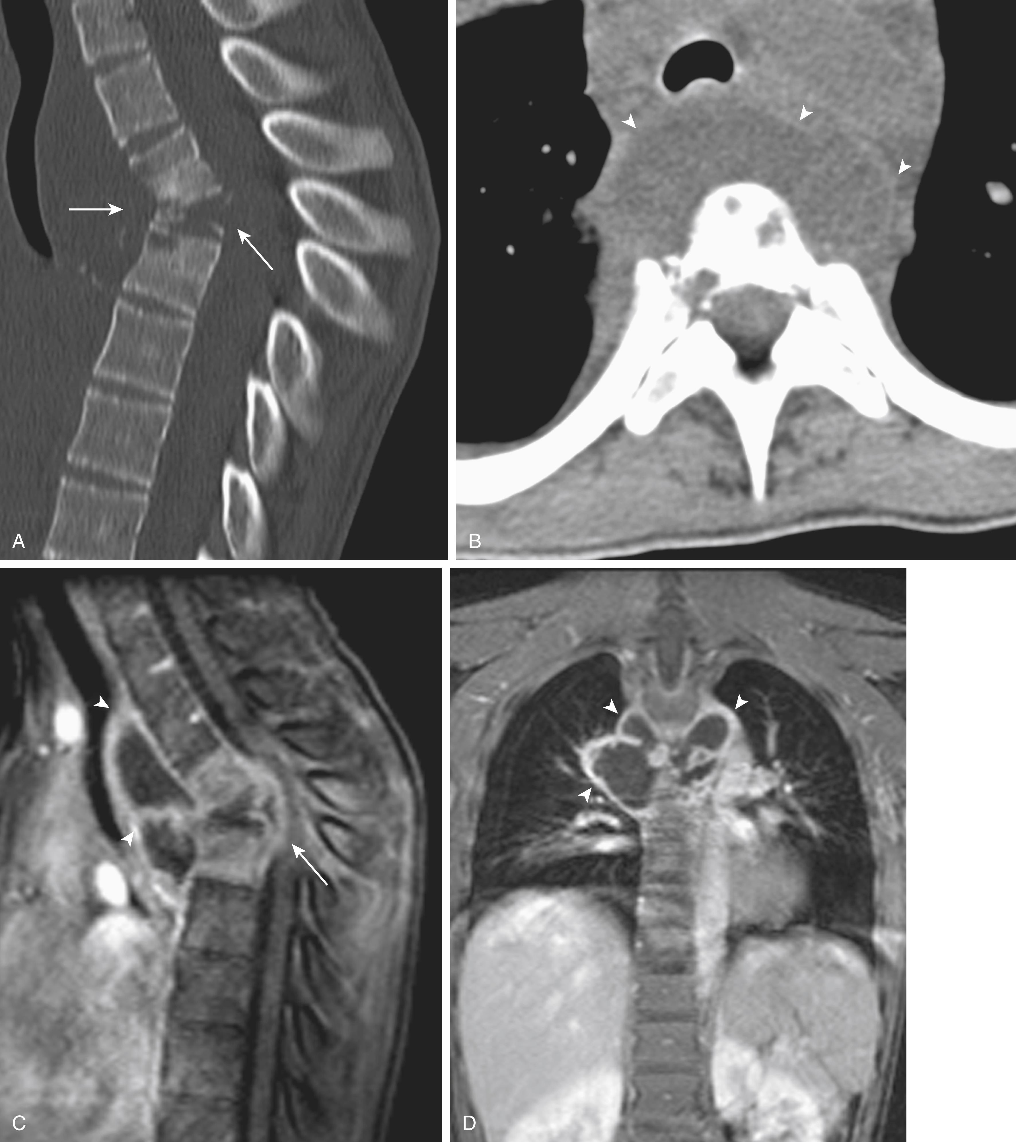 Fig. 46.7, Tuberculous osteomyelitis in a 13-year-old female with progressive loss of strength and coordination in legs. Sagittal reformatted (A) and axial soft tissue window (B) images from a CT of the spine, and sagittal (C) and coronal (D) fat-saturated postcontrast T1-weighted MRI of the thoracic spine demonstrate marked kyphosis at site of bony collapse at the level of the midthoracic spine ( arrows in A and C ), as well as surrounding soft tissue abscess ( arrowheads in B–D ), predominately anteriorly, at the same level.