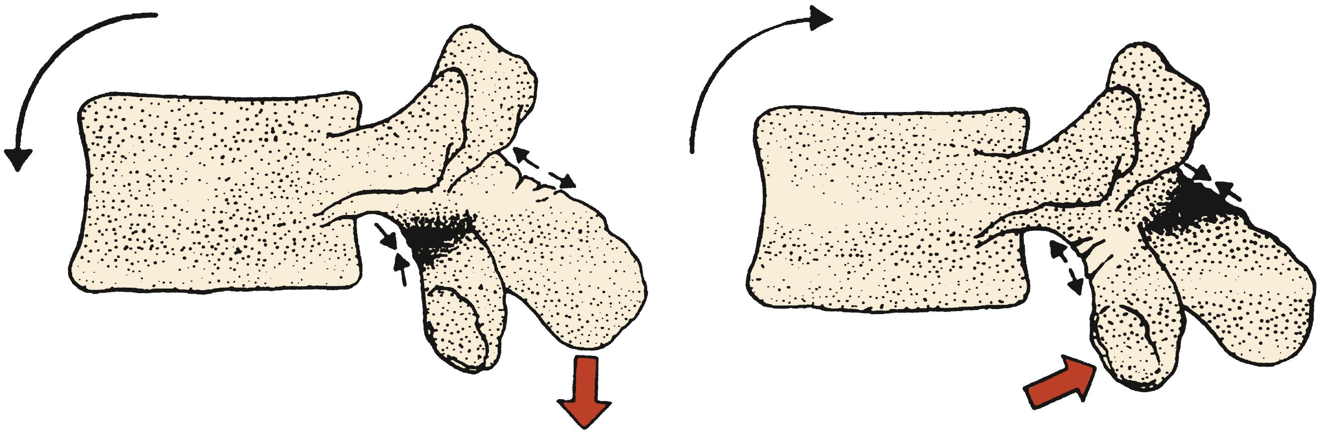 Fig. 46.8, Stress leading to fracture of the pars interarticularis.