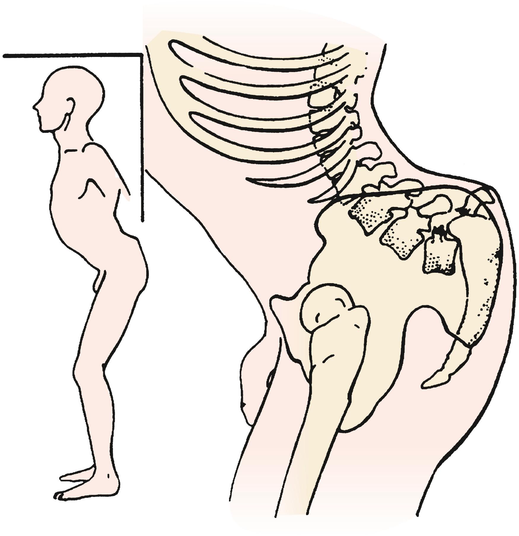 Fig. 46.9, Clinical picture of severe spondylolisthesis.