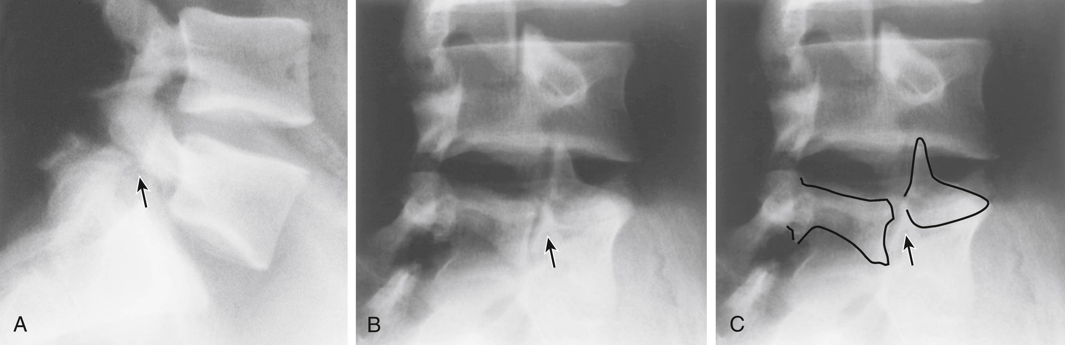 Fig. 46.10, A, Radiograph features of spondylolysis showing lytic defect (arrow) in the pars interarticularis. B, In isthmic defects, this appears as the collar (arrow) of the “Scotty dog” sign. C, Collar of the Scotty dog sign outlined on film.