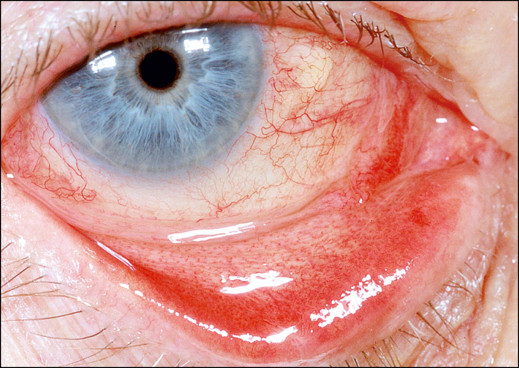 Fig. 37.2, Conjunctival papillae.