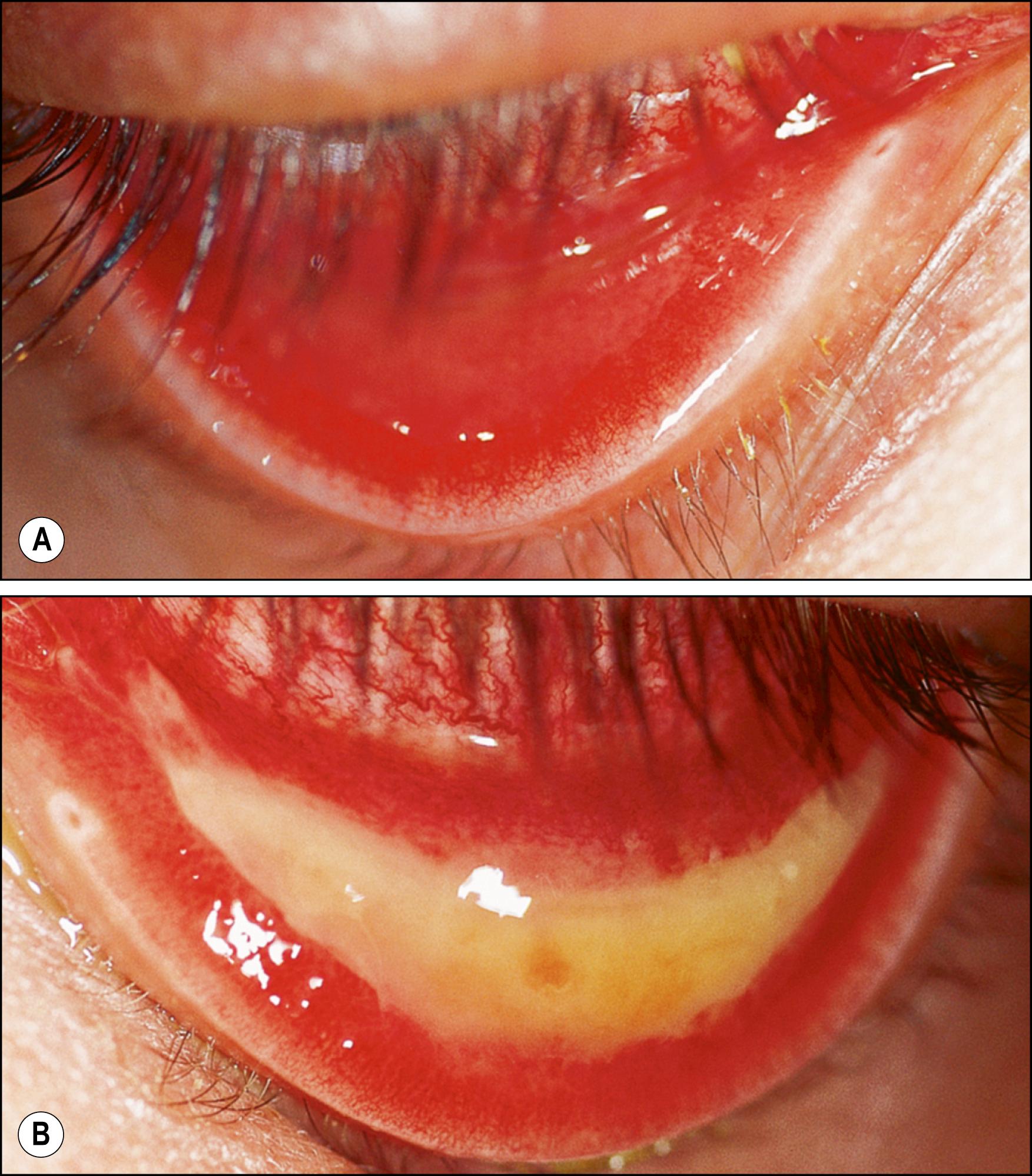 Fig. 37.4, ( A ) Follicles and hyperemia, ( B ) membranous or pseudomembranous conjunctivitis.
