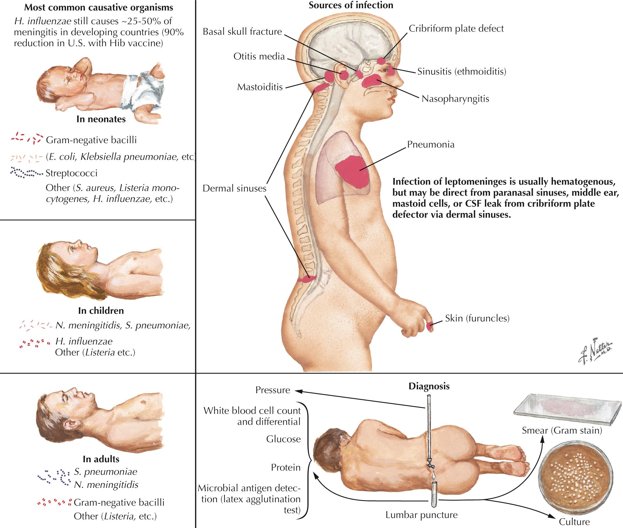 Fig. 44.1, Bacterial Meningitis–I.