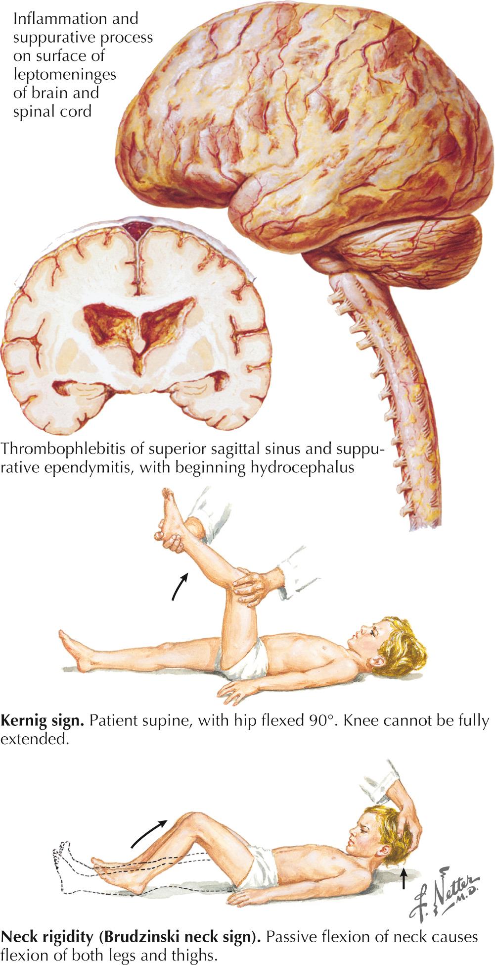 Fig. 44.2, Bacterial Meningitis–II.