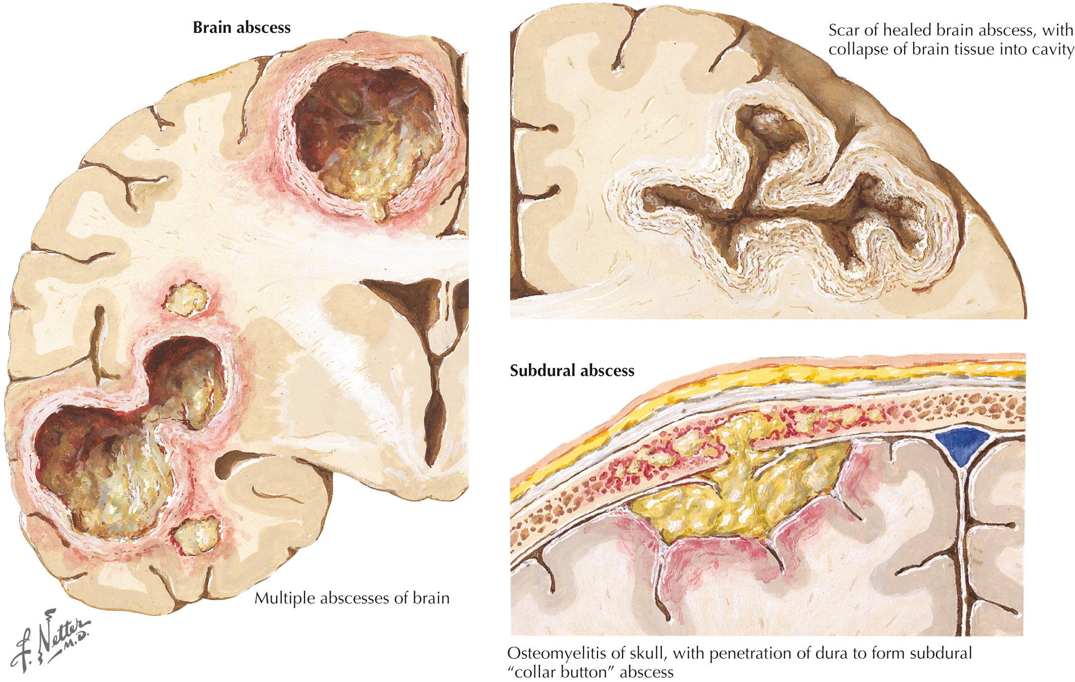 Fig. 44.3, Parameningeal Infections.