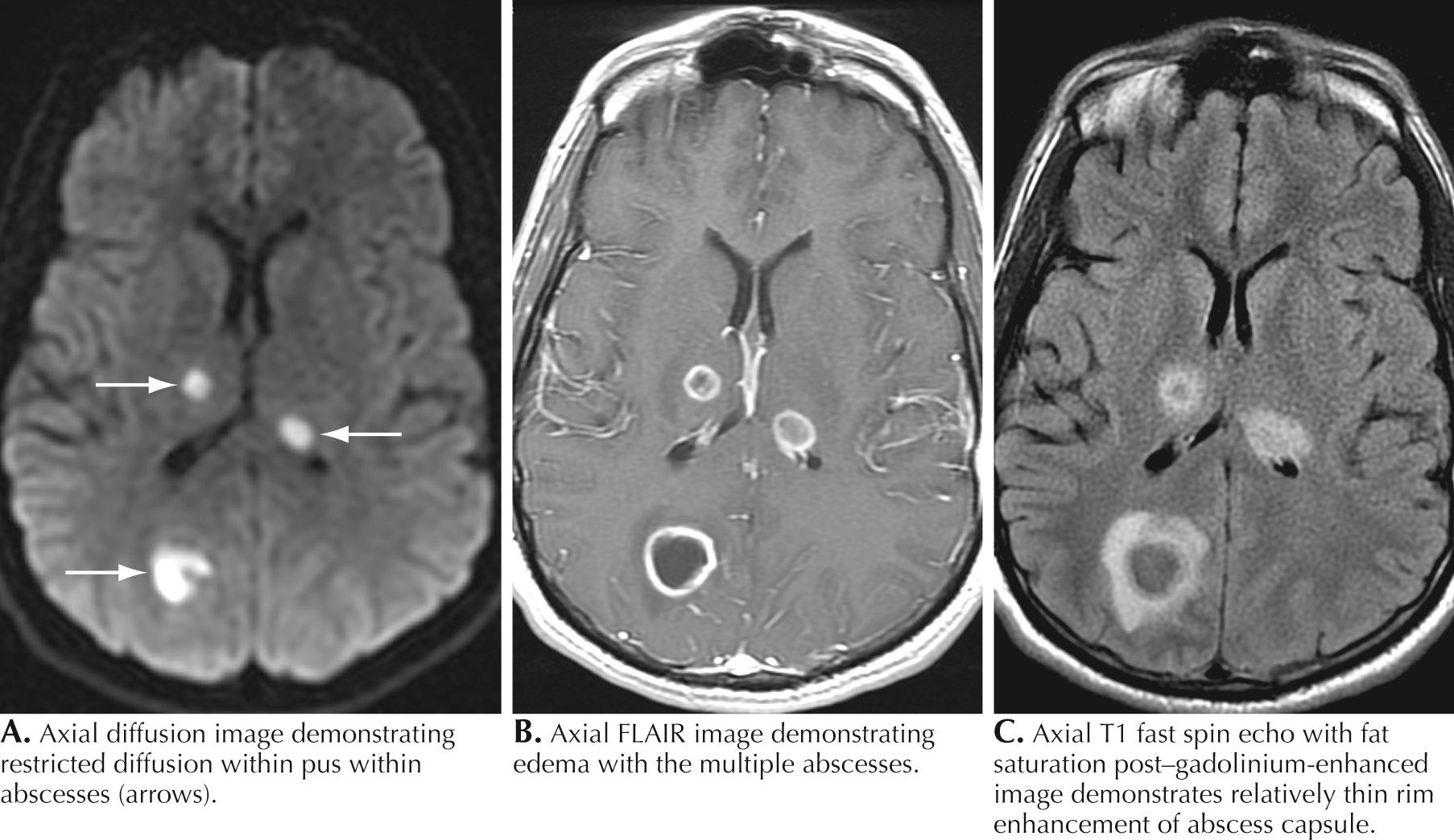 Fig. 44.4, Multiple Brain Abscesses in a 32-Year-Old With Septicemia.