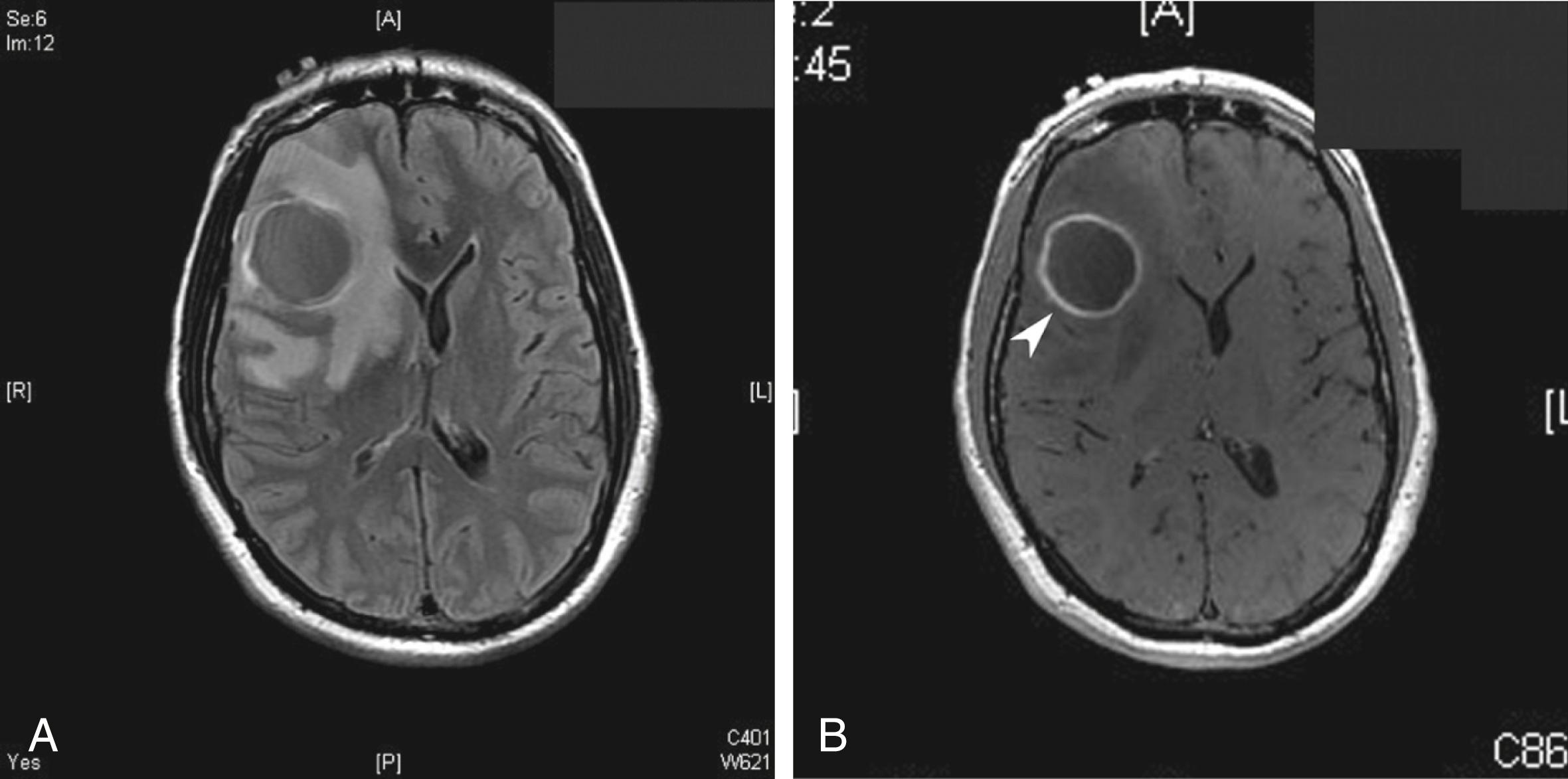 Fig. 79.1, Magnetic resonance imaging of a 47-year-old man with a new, progressive headache starting 1 week after infected tooth extraction. A, Fluid-attenuated inversion recovery (FLAIR) image showing the central hypodense lesion with surrounding edema. B, T1 image after gadolinium administration, which shows a thick rim of contrast enhancement around the lesion (white arrowhead) .