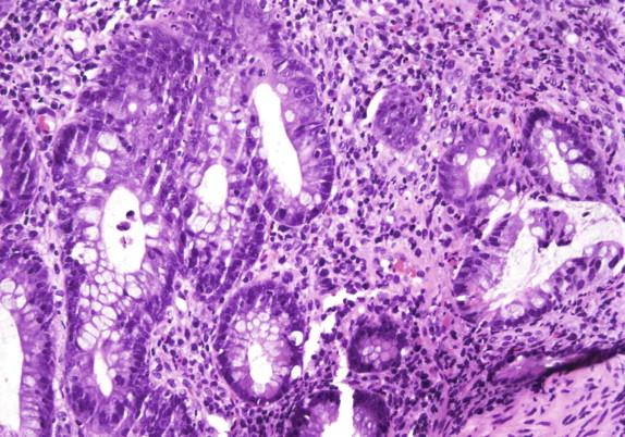 Figure 16-12, Patchy architectural distortion in Aeromonas colitis can mimic chronic idiopathic inflammatory bowel disease.