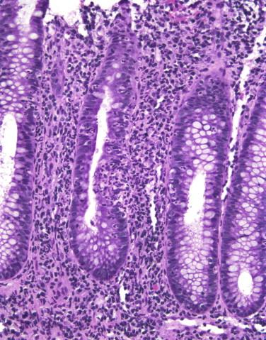 Figure 16-13, Campylobacter colitis featuring cryptitis, mucosal surface injury, and preservation of crypt architecture.