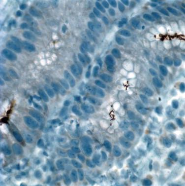 Figure 16-2, Helicobacter pylori are present within mucin at the surface of the glands and in the pits and have a “seagull” or “comma” shape ( H. pylori immunostain).