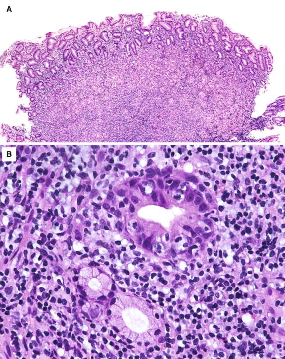 Figure 16-6, Gastric MALT lymphoma. A, This low-power view shows effacement of the normal gastric architecture by a dense infiltrate of small lymphocytes. B, Prominent lymphoepithelial lesions are easily identified.