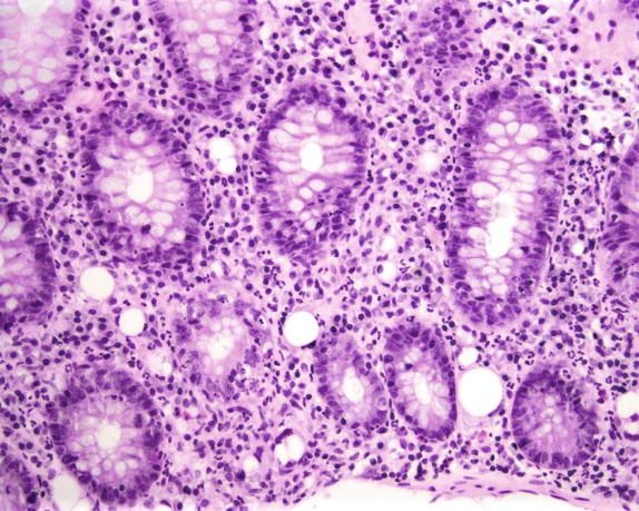 Figure 16-8, Acute infectious-type colitis pattern in a case of Campylobacter colitis. Note diffuse cryptitis, neutrophilic infiltrate in the lamina propria, and preservation of crypt architecture.