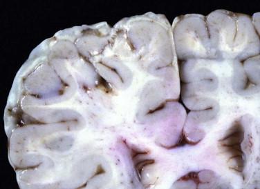 Fig 2, Acute purulent leptomeningitis. Coronal gross section of the brain shows the purulent exudate filling the subarachnoid space.