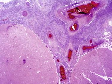 Fig 3, Acute purulent leptomeningitis. Low-magnification view shows an extensive fibrinopurulent exudate extending to the surface of the brain.