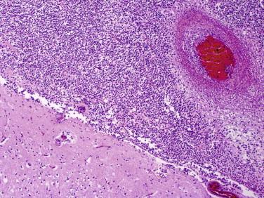 Fig 4, Acute purulent leptomeningitis. High-magnification view shows extensive neutrophilic inflammation with involvement of a subarachnoid blood vessel. Thrombosis of superficial blood vessels may lead to local ischemia and infarction.