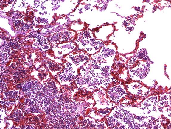 Figure 12-3, Acute pneumococcal pneumonia (microscopic): Distended capillaries and congestion with prominent neutrophilic infiltrate and erythrocytes.