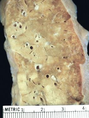 Figure 12-4, Haemophilum influenza pneumonia (gross): Nodular tan infiltrates with a lobular pattern with surrounding areas of consolidation.