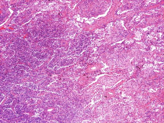 Figure 12-5, Haemophilum influenzae pneumonia (microscopic): Neutrophilic infiltrate in left and center of field with areas of fibroblastic organization on the right.