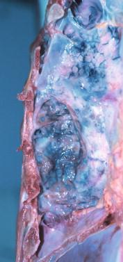 Figure 12-6, Staphylococcal empyema (gross): An autopsy lung with suppuration and fibrinous pleural adhesions present in a thoracic cavity-filled empyema.