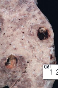 Figure 12-7, Staphylococcal pneumonia (gross): Thin-walled pneumatoceles with tan/yellow pus (left lower) are present in a tan/white consolidated lung.