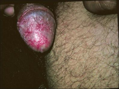 Figure 26-1, Circinate balanitis in a case of Reiter's syndrome.