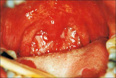 Figure 26-14, Buccopharyngeal gonorrhea. Observe edema and erythematous aspect of the uvula, pustular areas in the pharynx, and irregular erosions on the upper surface of the tongue.
