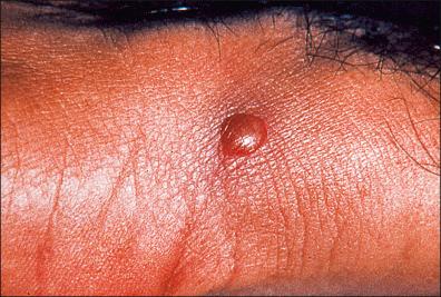 Figure 26-15, Gonococcal dermatitis, where it is possible to observe a pustule.