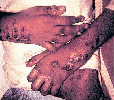 Figure 26-16, Rare case of gonococcemia, which signifies massive hematogenic dissemination of gonococci; it is normally more common in meningococcal disease. Diagnosis should include hemoculture.