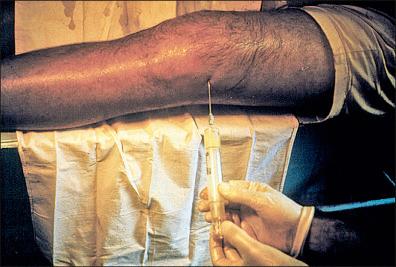 Figure 26-17, Patient with gonococcal arthritis; this is a bisexual man who also had gonococcal urethritis.