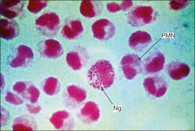 Figure 26-18, Presence of various Gram-negative intracellular reniform diplococci in some polymorphonuclear leukocytes (1000×).