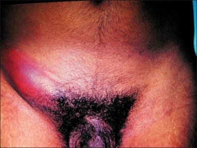 Figure 26-3, Lymphogranuloma venereum with massive inguinal lymphadenopathy.