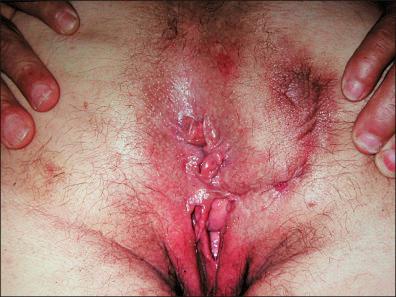 Figure 26-5, Later stage of lymphogranuloma venereum with perianal fistulas.