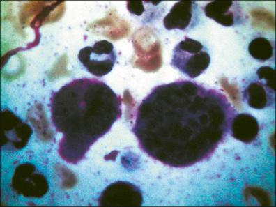 Figure 26-6, Staining of the smear (Giemsa, 400×) reveals the intracellular corpuscles of Gamna–Miyagawa.