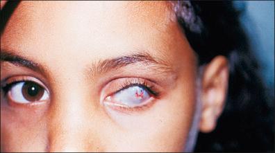 Figure 26-7, Severe sequel of neonatal ophthalmia. The mother reported that, during pregnancy, her husband had a “little infection” in the penis, treated at the pharmacy. The woman was not treated during her pregnancy.