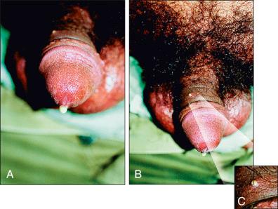 Figure 26-8, Typical clinical picture of purulent urethritis by gonococci. During the exam we noted a pustule on the penis (in the detail), which on bacterioscopy showed Gram-negative intracellular diplococci and the culture gave Nesseria gonorrhoeae . The patient had fever, cephalalgia, and myalgias, which indicate the beginning of a septicemic episode.